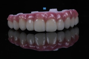 Fixed removable hybrid prosthesis